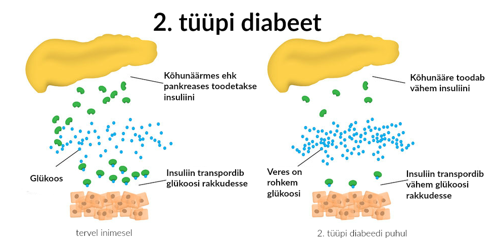 II tüüpi diabeet
